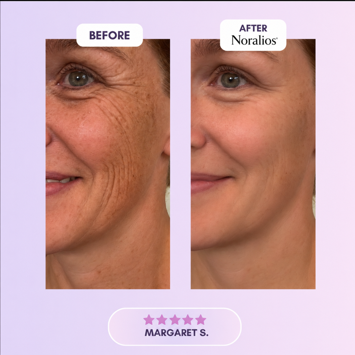 Noralios™ Silicone Collagen Sheet