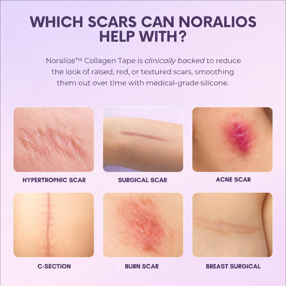 Noralios™ Silicone Collagen Sheet